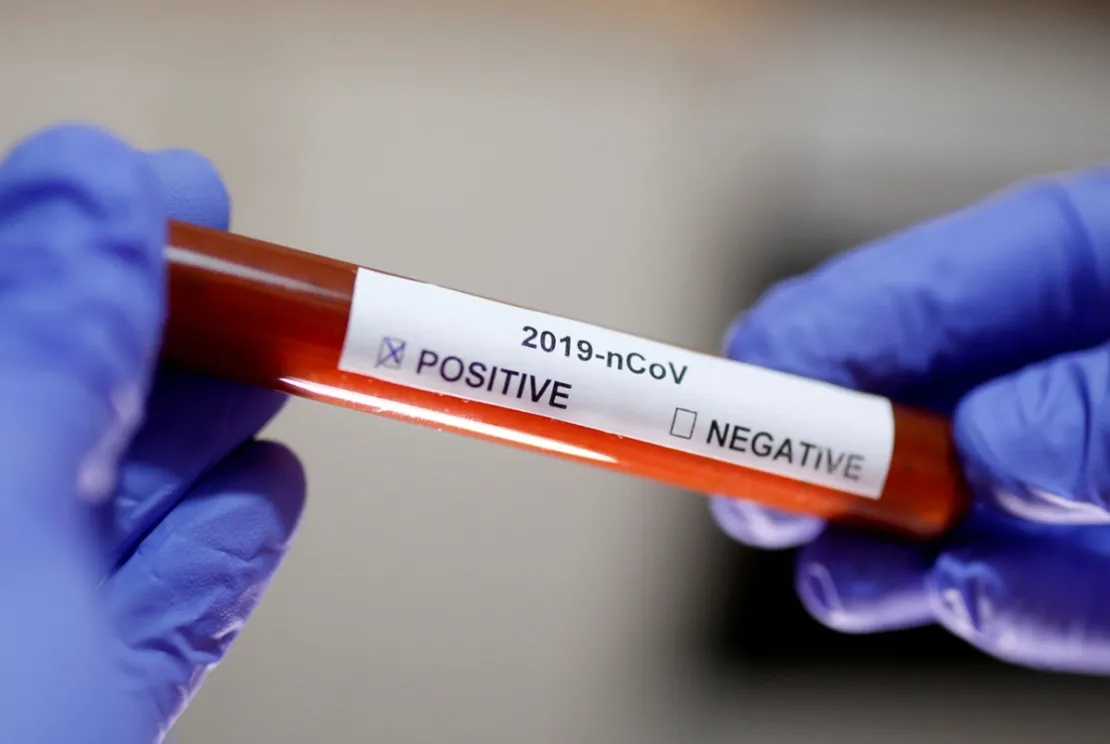 Hasil Tes PCR Positif Meskipun Sudah Sembuh. Mengapa Demikian?